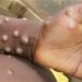 Monkeypox Virus : ਅਮਰੀਕਾ ‘ਚ ਵਧਿਆ Monkeypox ਦਾ ਪ੍ਰਕੋਪ, 7 ਸੂਬਿਆਂ ‘ਚ 9 ਨਵੇਂ ਮਾਮਲਿਆਂ ਦੀ ਪੁਸ਼ਟੀ