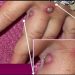 Monkeypox Virus Outbreak : ਕੱਪੜੇ ਤੇ ਤੌਲੀਆ ਬਿਲਕੁਲ ਵੀ ਨਾ ਕਰੋ ਸਾਂਝਾ, ਇਨ੍ਹਾਂ ਚੀਜ਼ਾਂ ਤੋਂ ਫੈਲਦਾ ਹੈ ਮੰਕੀਪੌਕਸ ਸੰਕ੍ਰਮਣ